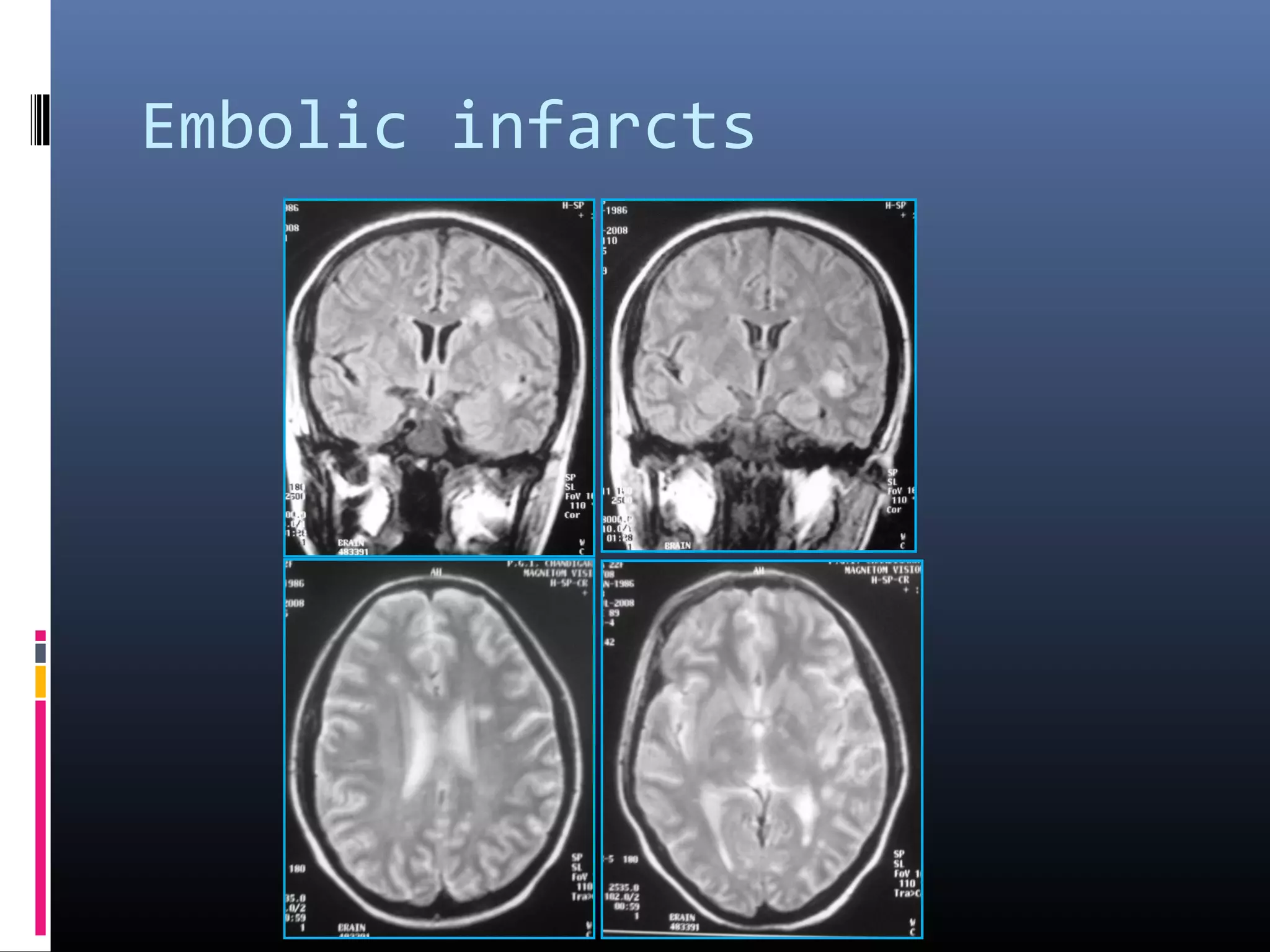 Embolic infarcts
 