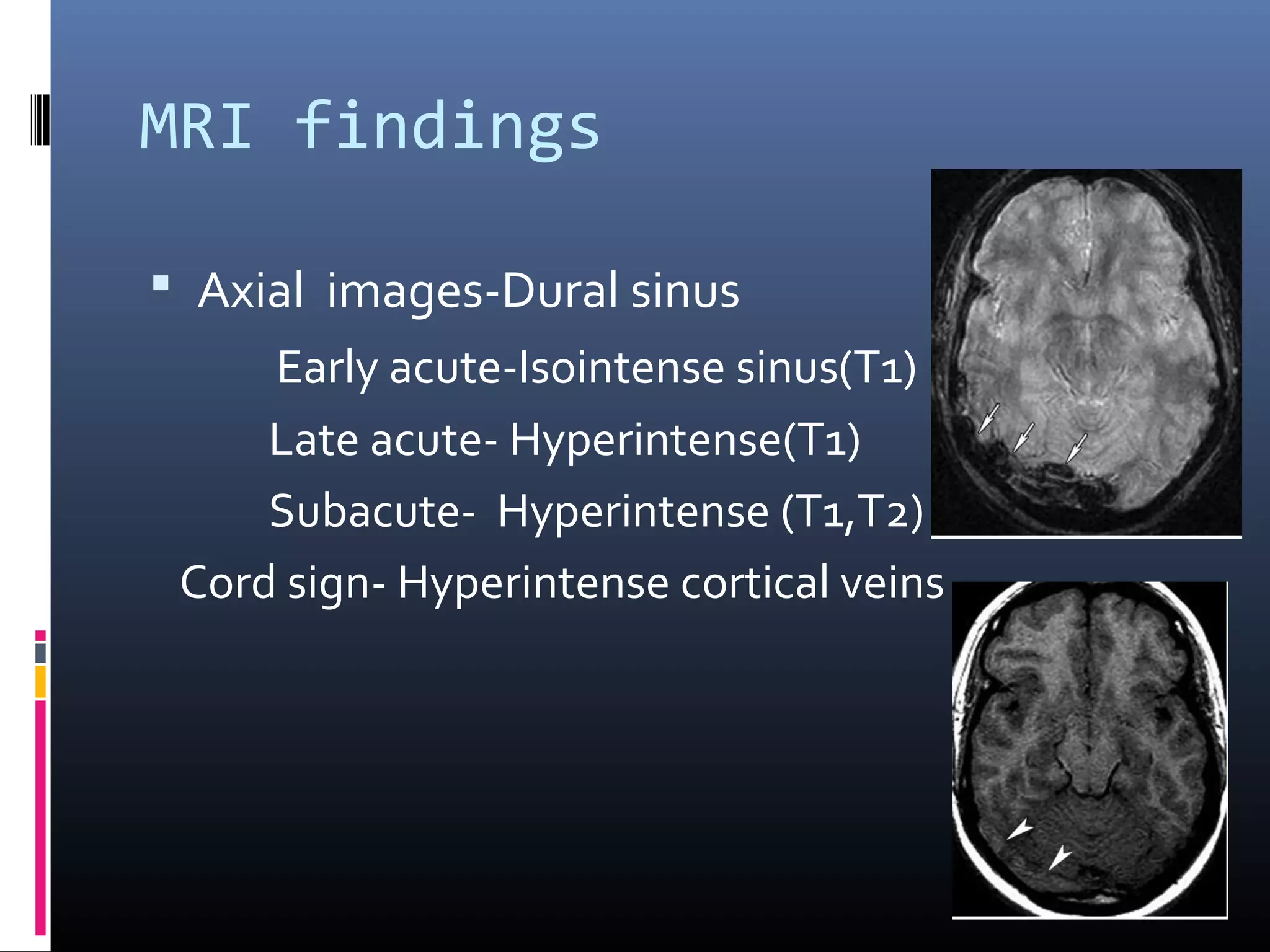 MRI findings
 Axial images-Dural sinus
Early acute-Isointense sinus(T1)
Late acute- Hyperintense(T1)
Subacute- Hyperintense (T1,T2)
Cord sign- Hyperintense cortical veins
 