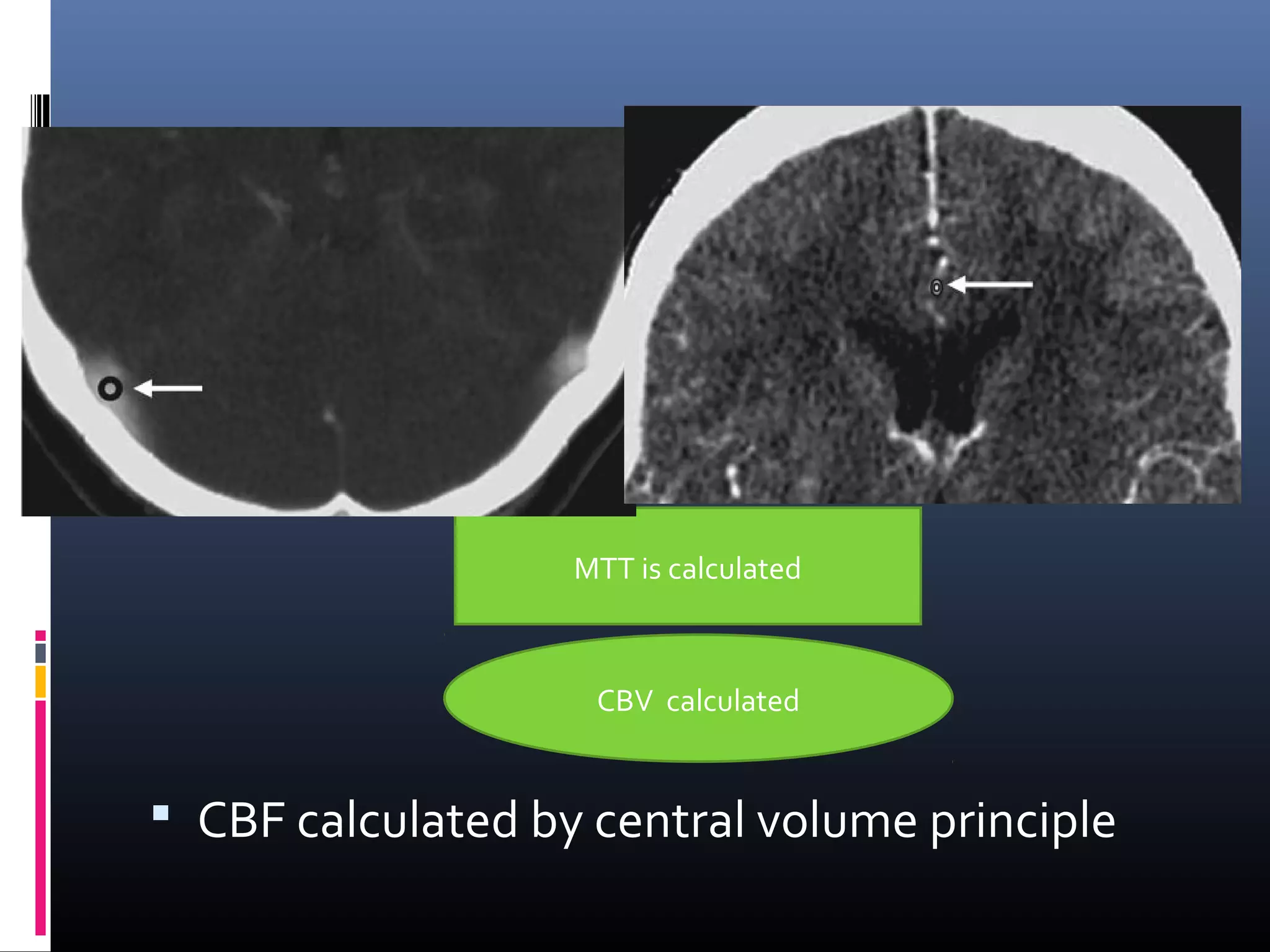  CBF calculated by central volume principle
ROI over artery ROI over vein
MTT is calculated
CBV calculated
ROI over parenchyma
 