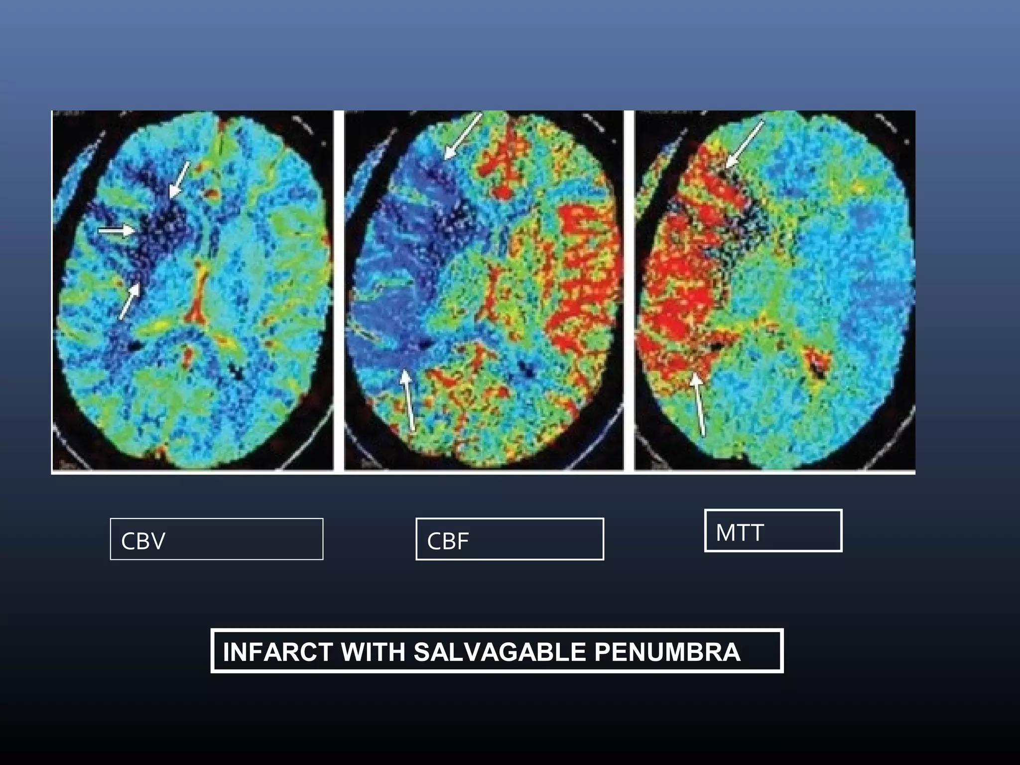 CBV CBF MTT
INFARCT WITH SALVAGABLE PENUMBRA
 