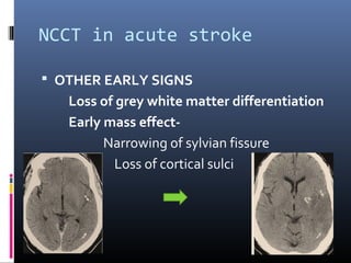 NCCT in acute stroke
 OTHER EARLY SIGNS
Loss of grey white matter differentiation
Early mass effect-
Narrowing of sylvian fissure
Loss of cortical sulci
 
