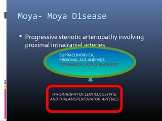 Moya- Moya Disease
 Progressive stenotic arteriopathy involving
proximal intracranial arteries
SUPRACLINOID ICA,
PROXIMAL ACA AND MCA
PCA RARELY, LATELY INVOLVED
HYPERTROPHY OF LENTICULOSTIATE
AND THALAMOPERFORATOR ARTERIES
 