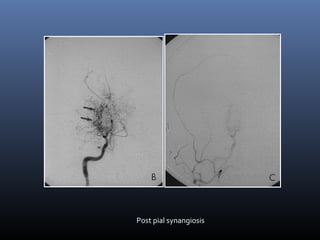 Post pial synangiosis
 