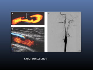 CAROTID DISSECTION
 
