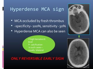 Hyperdense MCA sign
 MCA occluded by fresh thrombus
 -specificity- 100%, sensitivity -30%
 Hyperdense MCA can also be seen
ONLY REVERSIBLE EARLY SIGN
high hematocrit
level
 calcification
in such cases –
usually bilateral
 