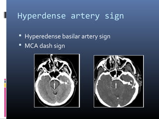 Hyperdense artery sign
 Hyperedense basilar artery sign
 MCA dash sign
 