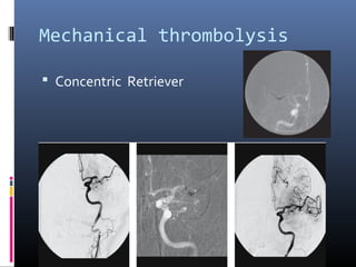 Mechanical thrombolysis
 Concentric Retriever
 