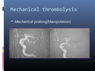 Mechanical thrombolysis
 Mechanical probing(Manipulation)
 