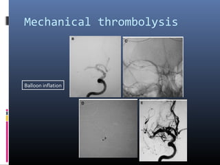 Mechanical thrombolysis
Balloon inflation
 