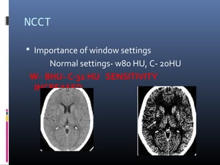 NCCT
 Importance of window settings
Normal settings- w80 HU, C- 20HU
W- 8HU- C-32 HU SENSITIVITY
INCREASED
 
