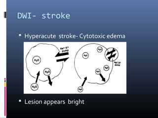 DWI- stroke
 Hyperacute stroke- Cytotoxic edema
 Lesion appears bright
 