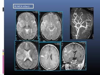 Rt MCA infarct
 