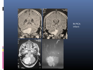 Rt PICA
infarct
 
