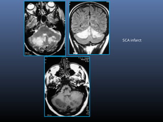 SCA infarct
 