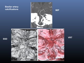 MIP
SSD
VRT
Basilar artery
calcifications
 