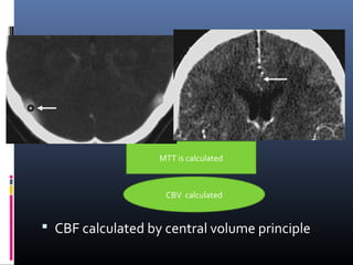  CBF calculated by central volume principle
ROI over artery ROI over vein
MTT is calculated
CBV calculated
ROI over parenchyma
 