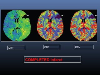 MTT CBF CBV
COMPLETED infarct
 