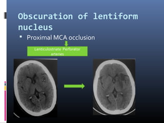 Obscuration of lentiform
nucleus
 Proximal MCA occlusion
Lenticulostriate Perforator
arteries
 