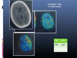 ISCHEMIC CORE
CT PERFUSION
CBF 30%
CBV 54%
 