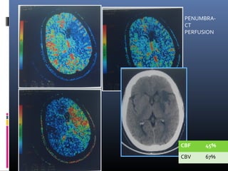 PENUMBRA-
CT
PERFUSION
CBF 45%
CBV 67%
 