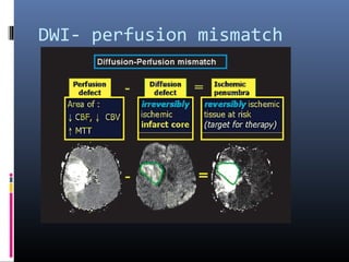 DWI- perfusion mismatch
 