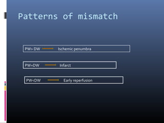 Patterns of mismatch
PW> DW Ischemic penumbra
PW=DW Infarct
PW<DW Early reperfusion
 