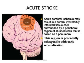 ACUTE STROKE
 Acute cerebral ischemia may
result in a central irreversibly
infarcted tissue core
surrounded by a peripheral
region of stunned cells that is
called as a penumbra
 This region is potentially
salvageable with early
recanalization
DR.SVM MDRD
 