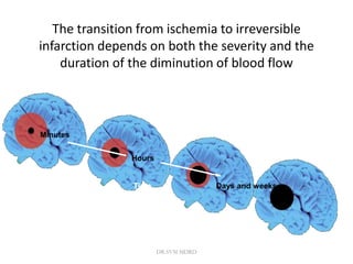 The transition from ischemia to irreversible
infarction depends on both the severity and the
duration of the diminution of blood flow
Minutes
Days and weeks
Time
Hours
DR.SVM MDRD
 