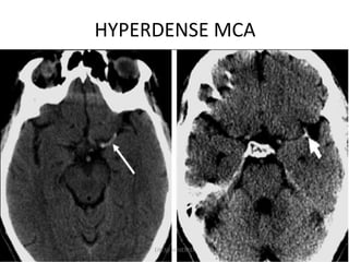 HYPERDENSE MCA
DR.SVM MDRD
 