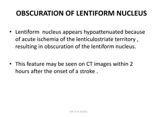 OBSCURATION OF LENTIFORM NUCLEUS
• Lentiform nucleus appears hypoattenuated because
of acute ischemia of the lenticulostriate territory ,
resulting in obscuration of the lentiform nucleus.
• This feature may be seen on CT images within 2
hours after the onset of a stroke .
DR.SVM MDRD
 
