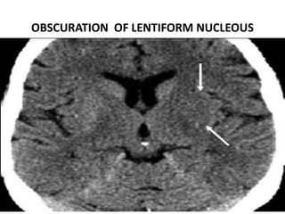 OBSCURATION OF LENTIFORM NUCLEOUS
DR.SVM MDRD
 