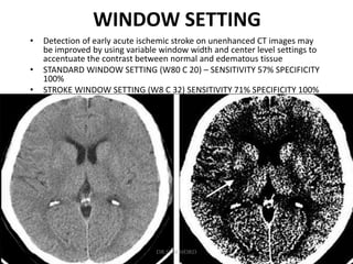 WINDOW SETTING
• Detection of early acute ischemic stroke on unenhanced CT images may
be improved by using variable window width and center level settings to
accentuate the contrast between normal and edematous tissue
• STANDARD WINDOW SETTING (W80 C 20) – SENSITIVITY 57% SPECIFICITY
100%
• STROKE WINDOW SETTING (W8 C 32) SENSITIVITY 71% SPECIFICITY 100%
DR.SVM MDRD
 