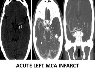 ACUTE LEFT MCA INFARCT
DR.SVM MDRD
 