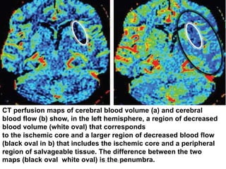 CT perfusion maps of cerebral blood volume (a) and cerebral
blood flow (b) show, in the left hemisphere, a region of decreased
blood volume (white oval) that corresponds
to the ischemic core and a larger region of decreased blood flow
(black oval in b) that includes the ischemic core and a peripheral
region of salvageable tissue. The difference between the two
maps (black oval white oval) is the penumbra.
DR.SVM MDRD
 