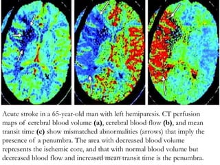 Acute stroke in a 65-year-old man with left hemiparesis. CT perfusion
maps of cerebral blood volume (a), cerebral blood flow (b), and mean
transit time (c) show mismatched abnormalities (arrows) that imply the
presence of a penumbra. The area with decreased blood volume
represents the ischemic core, and that with normal blood volume but
decreased blood flow and increased mean transit time is the penumbra.
DR.SVM MDRD
 