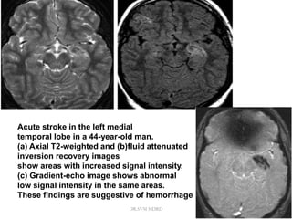 Acute stroke in the left medial
temporal lobe in a 44-year-old man.
(a) Axial T2-weighted and (b)fluid attenuated
inversion recovery images
show areas with increased signal intensity.
(c) Gradient-echo image shows abnormal
low signal intensity in the same areas.
These findings are suggestive of hemorrhage
DR.SVM MDRD
 