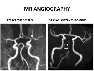 MR ANGIOGRAPHY
LEFT ICA THROMBUS BASILAR ARTERY THROMBUS
DR.SVM MDRD
 