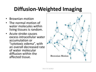 Diffusion-Weighted Imaging
• Brownian motion
• The normal motion of
water molecules within
living tissues is random.
• Acute stroke causes
excess intracellular water
accumulation or
“cytotoxic edema”, with
an overall decreased rate
of water molecular
diffusion within the
affected tissue. Brownian Motion
DR.SVM MDRD
 