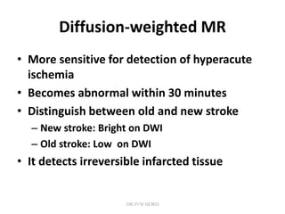 Diffusion-weighted MR
• More sensitive for detection of hyperacute
ischemia
• Becomes abnormal within 30 minutes
• Distinguish between old and new stroke
– New stroke: Bright on DWI
– Old stroke: Low on DWI
• It detects irreversible infarcted tissue
DR.SVM MDRD
 