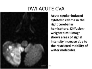 DWI ACUTE CVA
Acute stroke–induced
cytotoxic edema in the
right cerebellar
hemisphere. Diffusion-
weighted MR image
shows areas of signal
intensity increase due to
the restricted mobility of
water molecules
DR.SVM MDRD
 