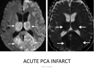ACUTE PCA INFARCT
DR.SVM MDRD
 