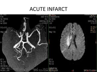 ACUTE INFARCT
DR.SVM MDRD
 