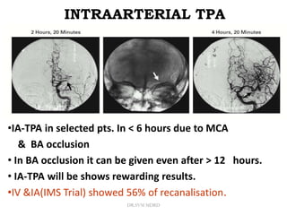 INTRAARTERIAL TPA
•IA-TPA in selected pts. In < 6 hours due to MCA
& BA occlusion
• In BA occlusion it can be given even after > 12 hours.
• IA-TPA will be shows rewarding results.
•IV &IA(IMS Trial) showed 56% of recanalisation.
DR.SVM MDRD
 