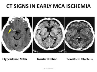 CT SIGNS IN EARLY MCA ISCHEMIA
Hyperdense MCA Insular Ribbon Lentiform Nucleus
DR.SVM MDRD
 