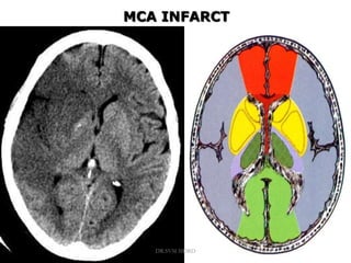 MCA INFARCT
DR.SVM MDRD
 
