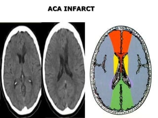 ACA INFARCT
DR.SVM MDRD
 