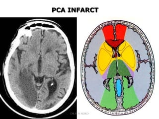 PCA INFARCT
DR.SVM MDRD
 
