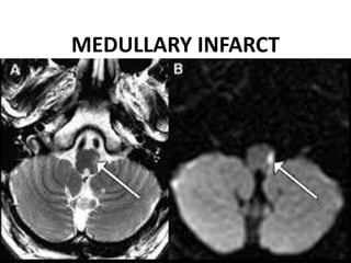 MEDULLARY INFARCT
DR.SVM MDRD
 