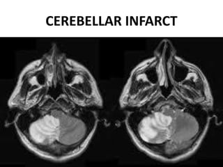 CEREBELLAR INFARCT
DR.SVM MDRD
 