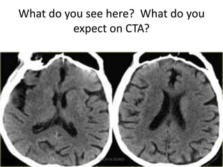 What do you see here? What do you
expect on CTA?
DR.SVM MDRD
 